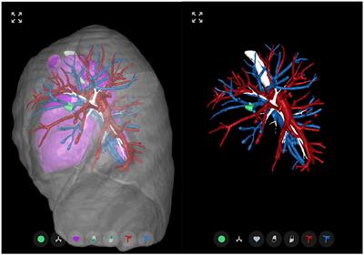 Surgeon Knowledge of the Pulmonary Arterial System and Surgical Plan Confidence Is Improved by Interactive Virtual 3D-CT Models of Lung Cancer Patient Anatomies